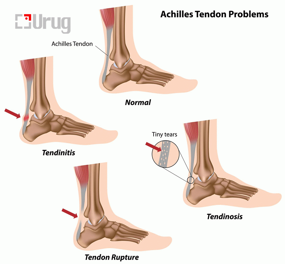 achilles-tendon-injuries-symptoms-causes-diagnosis-treatment